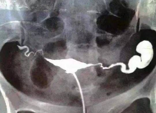 输卵管积水必须切输卵管吗？