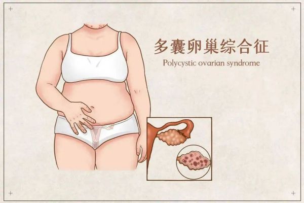 月经不调、变丑、不孕……困住不少女性的多囊卵巢综合征是什么？
