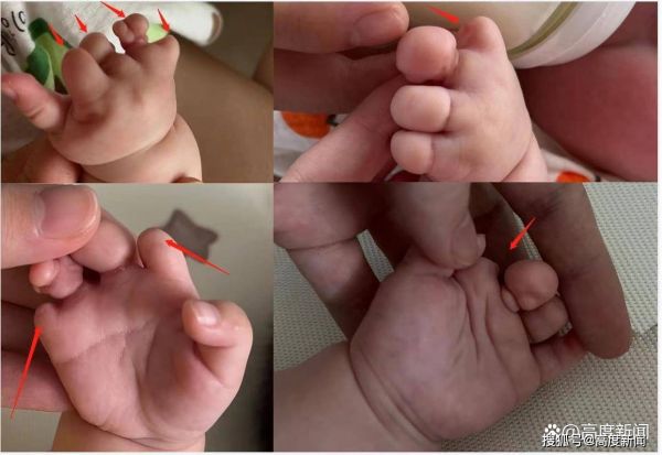 试管婴儿7个手指畸形,20多次产检未发现,家属质疑宜春妇保漏诊